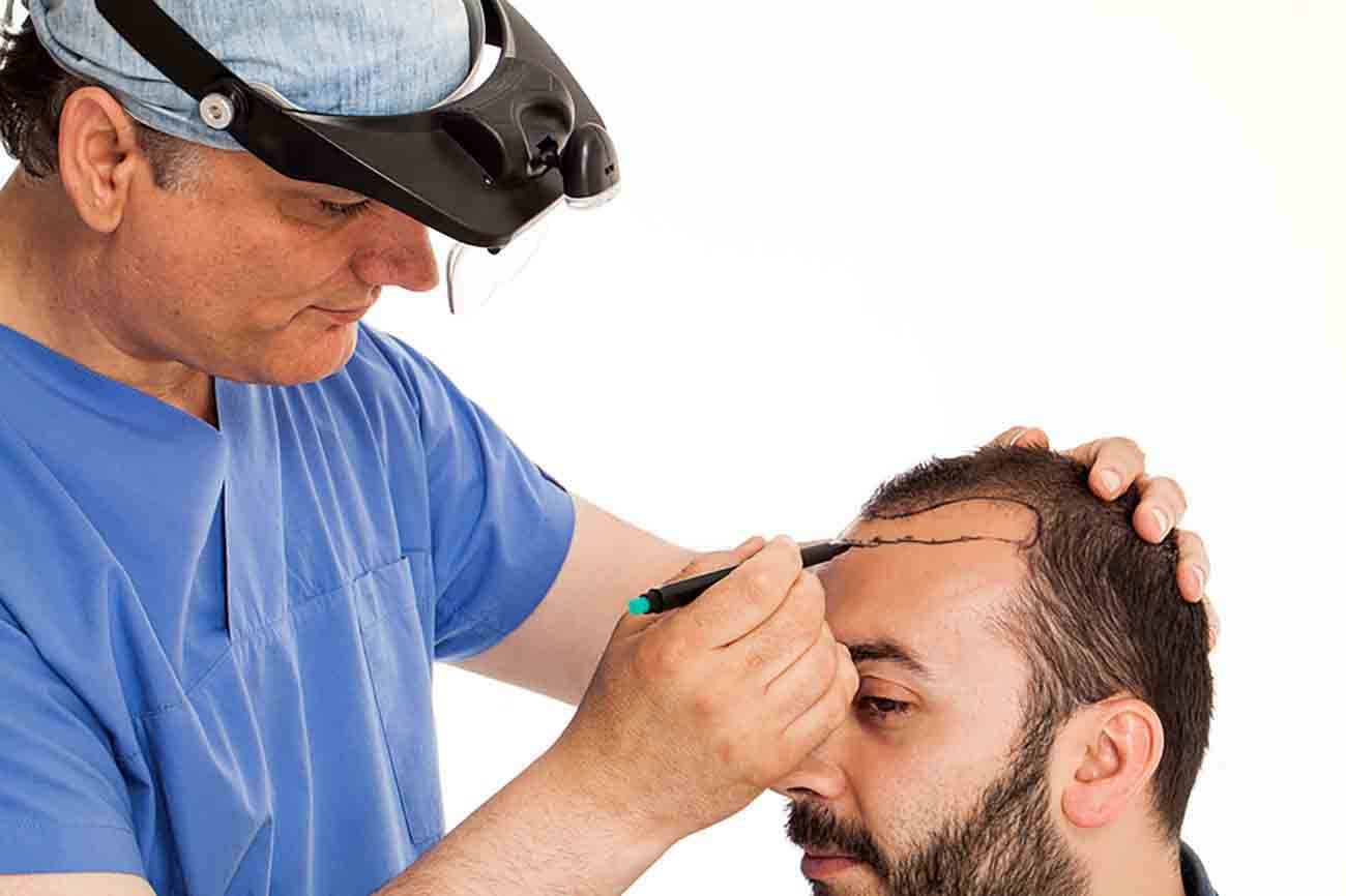 افضل مراكز زراعة الشعر في تركيا